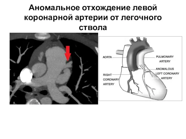 Аномальное отхождение левой коронарной артерии от легочного ствола