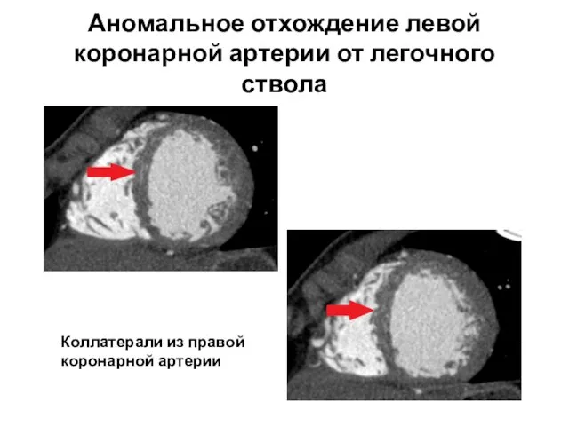 Аномальное отхождение левой коронарной артерии от легочного ствола Коллатерали из правой коронарной артерии