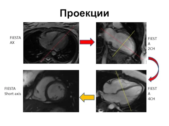 Проекции FIESTA AX FIESTA 2CH FIESTA 4CH FIESTA Short axis