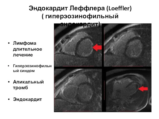 Лимфома длительное лечение Гиперэозинофильный синдом Апикальный тромб Эндокардит Эндокардит Леффлера (Loeffler) ( гиперэозинофильный эндокардит)