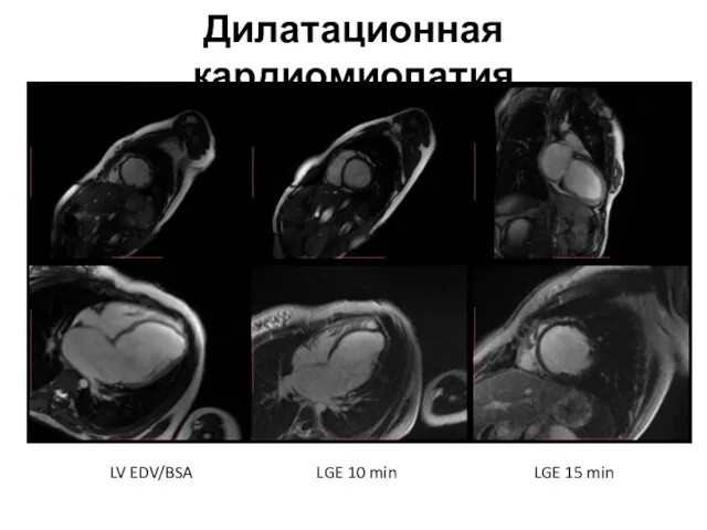 Дилатационная кардиомиопатия LGE 10 min LGE 15 min LV EDV/BSA