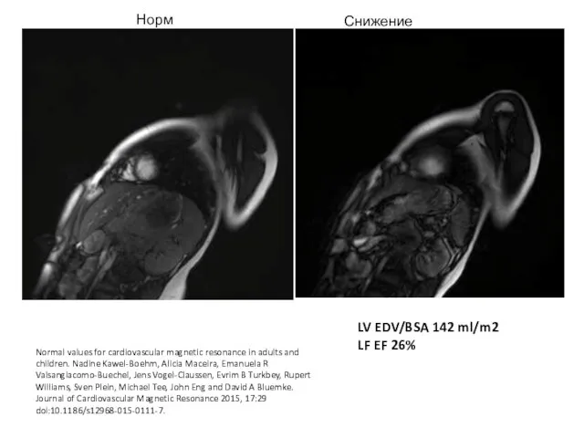 Норма Снижение сократимости LV EDV/BSA 142 ml/m2 LF EF 26% Normal values