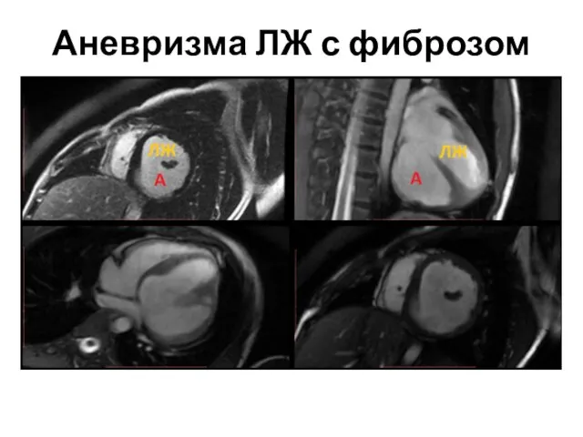 Аневризма ЛЖ с фиброзом