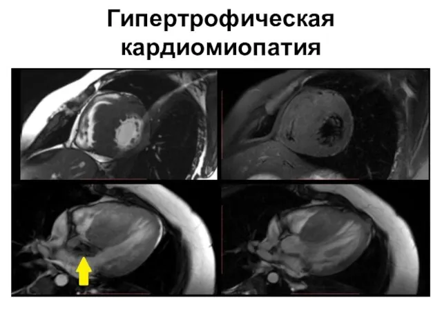 Гипертрофическая кардиомиопатия