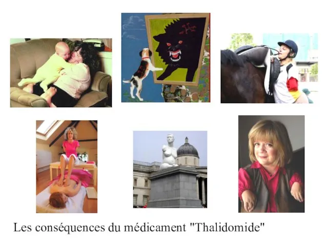 Les conséquences du médicament "Thalidomide"