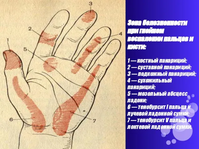 Зона болезненности при гнойном воспалении пальцев и кисти: 1 — костный панариций;