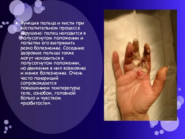 Функция пальца и кисти при воспалительном процессе нарушена: палец находится в полусогнутом