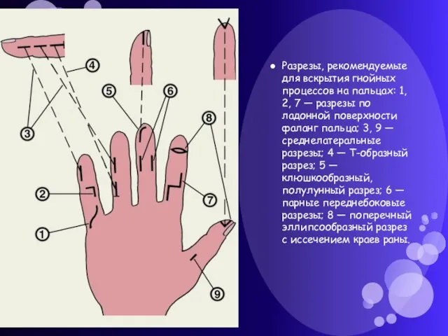 Разрезы, рекомендуемые для вскрытия гнойных процессов на пальцах: 1, 2, 7 —
