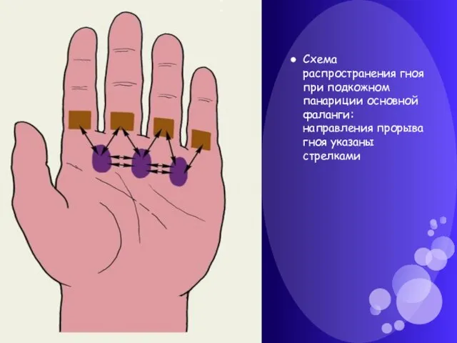 Схема распространения гноя при подкожном панариции основной фаланги: направления прорыва гноя указаны стрелками