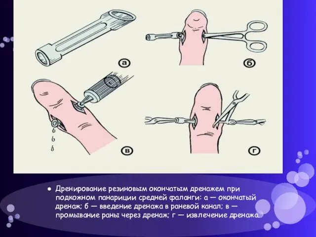 Дренирование резиновым окончатым дренажем при подкожном панариции средней фаланги: а — окончатый