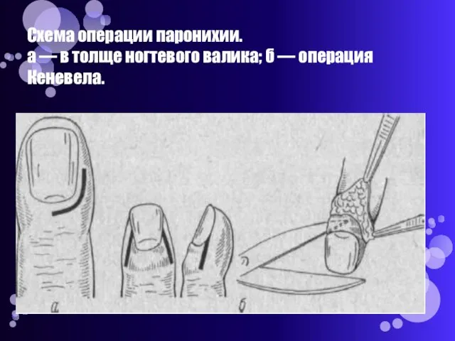 Схема операции паронихии. а — в толще ногтевого валика; б — операция Кеневела.