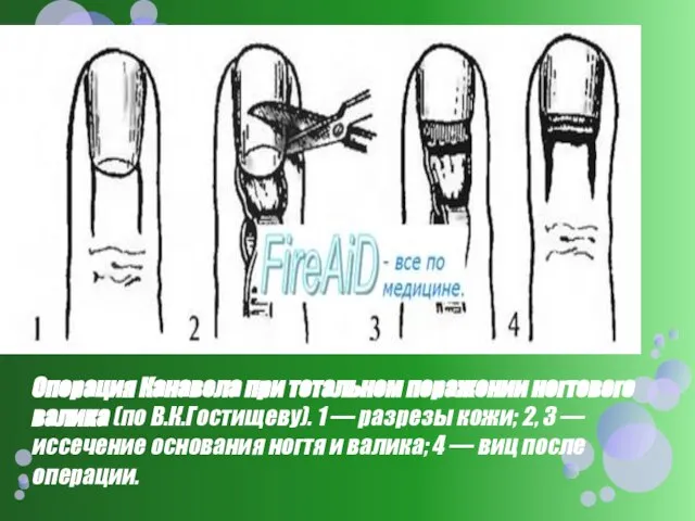 Операция Канавела при тотальном поражении ногтевого валика (по В.К.Гостищеву). 1 — разрезы