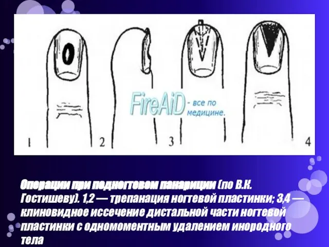 Операции при подногтевом панариции (по В.К.Гостишеву). 1,2 — трепанация ногтевой пластинки; 3,4