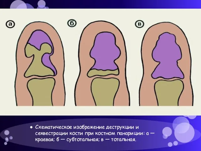 Схематическое изображение деструкции и секвестрации кости при костном панариции: а — краевая;