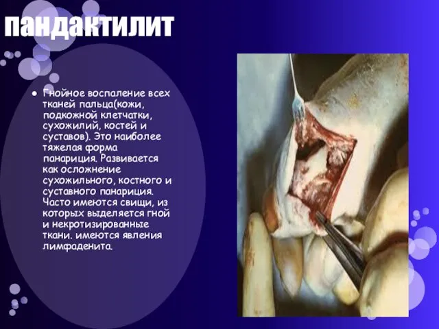 пандактилит Гнойное воспаление всех тканей пальца(кожи, подкожной клетчатки, сухожилий, костей и суставов).