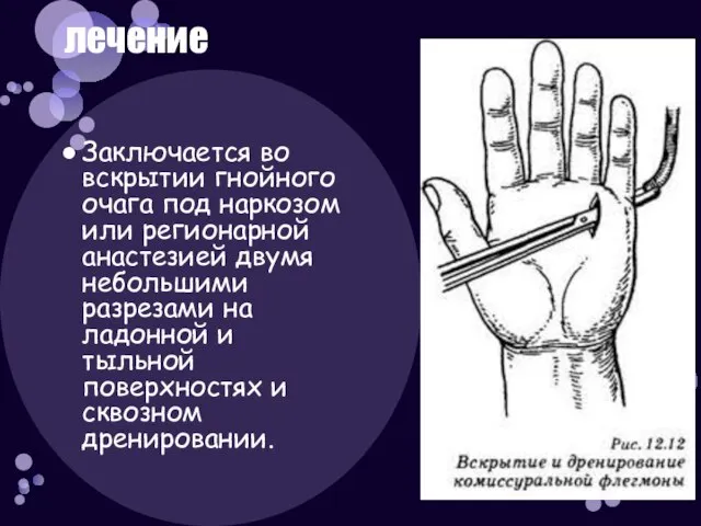 Заключается во вскрытии гнойного очага под наркозом или регионарной анастезией двумя небольшими