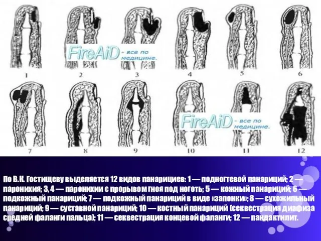 По В.К. Гостищеву выделяется 12 видов панарициев: 1 — подногтевой панариций; 2