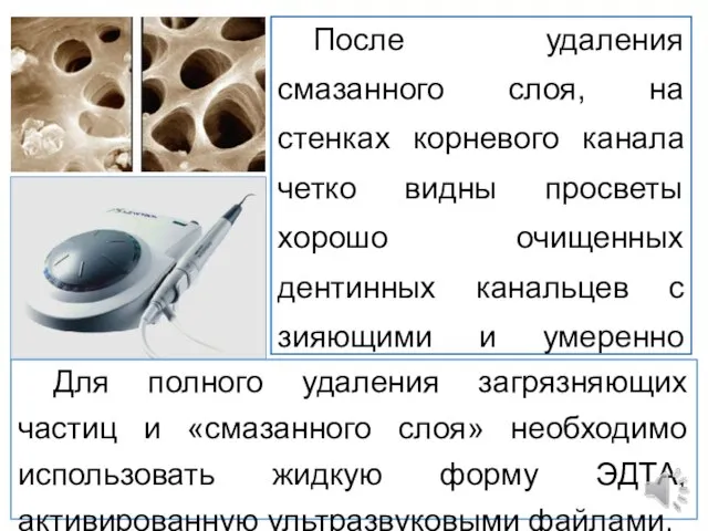 После удаления смазанного слоя, на стенках корневого канала четко видны просветы хорошо