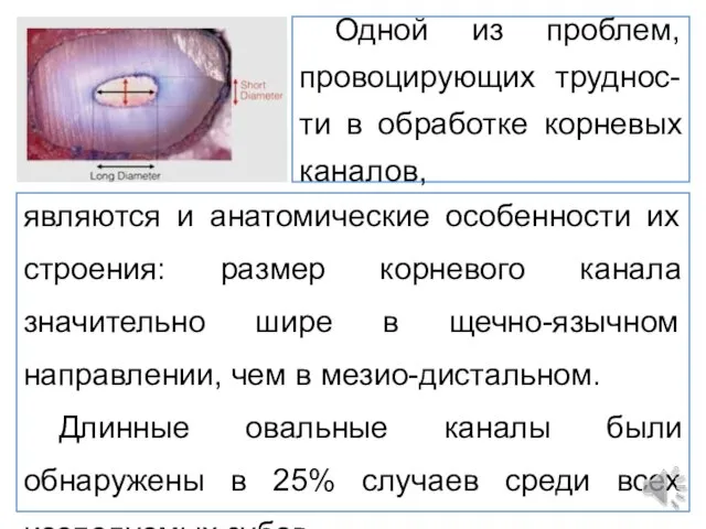 Одной из проблем, провоцирующих труднос-ти в обработке корневых каналов, являются и анатомические