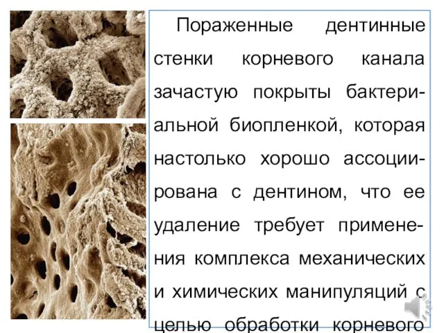 Пораженные дентинные стенки корневого канала зачастую покрыты бактери-альной биопленкой, которая настолько хорошо