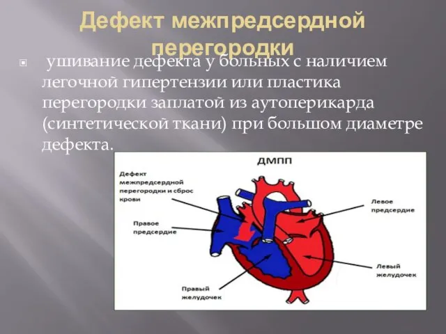 Дефект межпредсердной перегородки ушивание дефекта у больных с наличием легочной гипертензии или