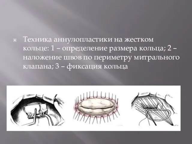 Техника аннулопластики на жестком кольце: 1 – определение размера кольца; 2 –