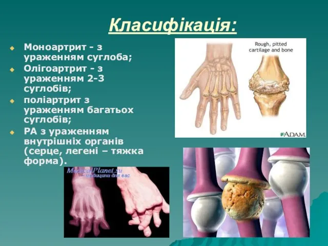 Класифікація: Моноартрит - з ураженням суглоба; Олігоартрит - з ураженням 2-3 суглобів;
