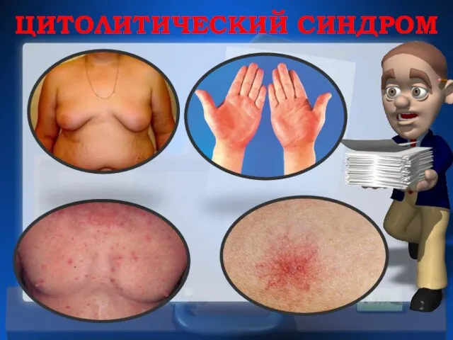 ЦИТОЛИТИЧЕСКИЙ СИНДРОМ