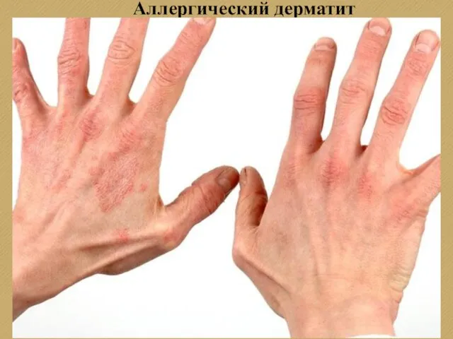 Аллергический дерматит