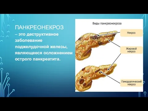 ПАНКРЕОНЕКРОЗ – это деструктивное заболевание поджелудочной железы, являющееся осложнением острого панкреатита.