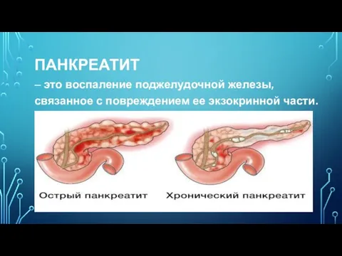 ПАНКРЕАТИТ – это воспаление поджелудочной железы, связанное с повреждением ее экзокринной части.
