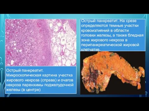 Острый панкреатит. Микроскопическая картина участка жирового некроза (справа) и очагов некроза паренхимы