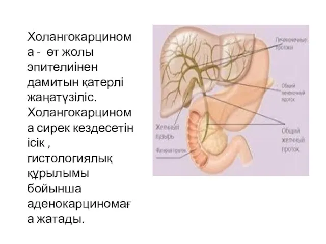 Холангокарцинома - өт жолы эпителиінен дамитын қатерлі жаңатүзіліс. Холангокарцинома сирек кездесетін ісік