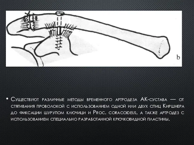 Существуют различные методы временного артродеза АК-сустава — от стягивания проволокой с использованием