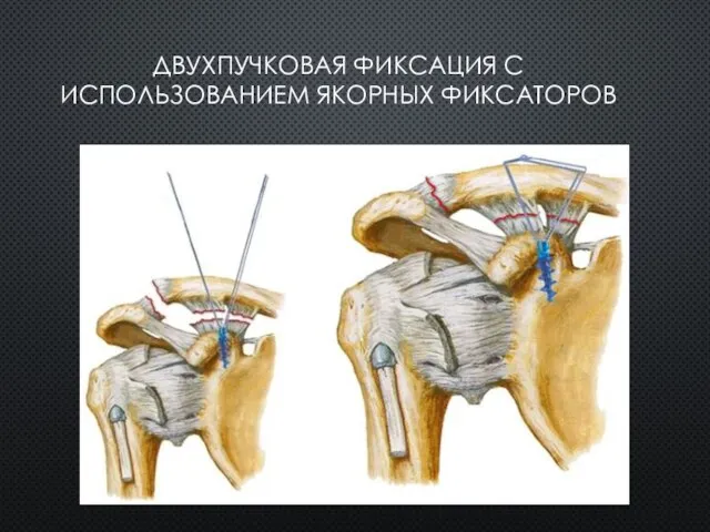 ДВУХПУЧКОВАЯ ФИКСАЦИЯ С ИСПОЛЬЗОВАНИЕМ ЯКОРНЫХ ФИКСАТОРОВ