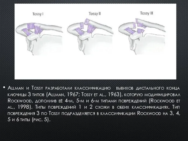 Allman и Tossy разработали классификацию вывихов дистального конца ключицы 3 типов (Allman,