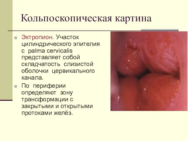 Кольпоскопическая картина Эктропион. Участок цилиндрического эпителия с palma cervicalis представляет собой складчатость