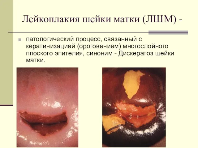 Лейкоплакия шейки матки (ЛШМ) - патологический процесс, связанный с кератинизацией (ороговением) многослойного