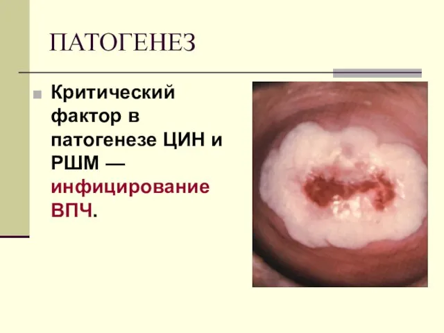 ПАТОГЕНЕЗ Критический фактор в патогенезе ЦИН и РШМ — инфицирование ВПЧ.