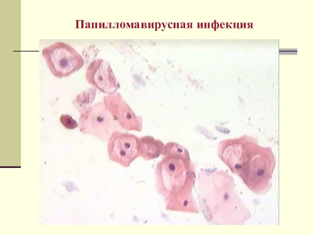 Папилломавирусная инфекция