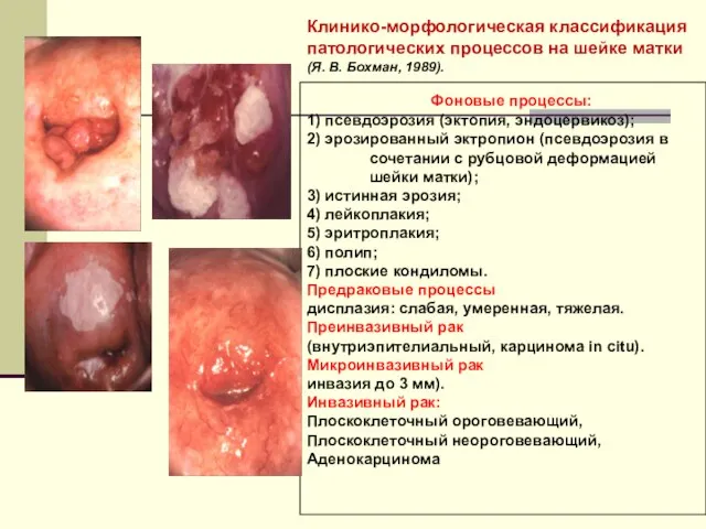 Клинико-морфологическая классификация патологических процессов на шейке матки (Я. В. Бохман, 1989). Фоновые