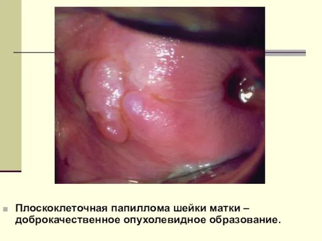 РИСУНОК 4. Плоскоклеточная папиллома шейки матки – доброкачественное опухолевидное образование.