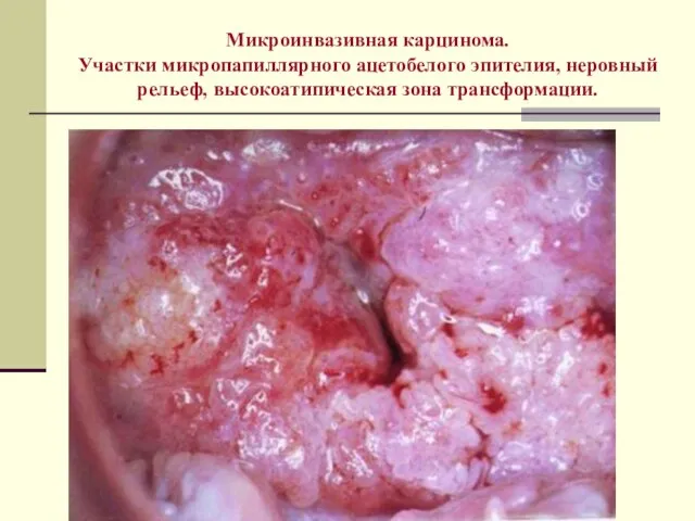 Микроинвазивная карцинома. Участки микропапиллярного ацетобелого эпителия, неровный рельеф, высокоатипическая зона трансформации.