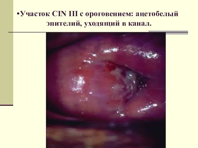 Участок CIN III c ороговением: ацетобелый эпителий, уходящий в канал.