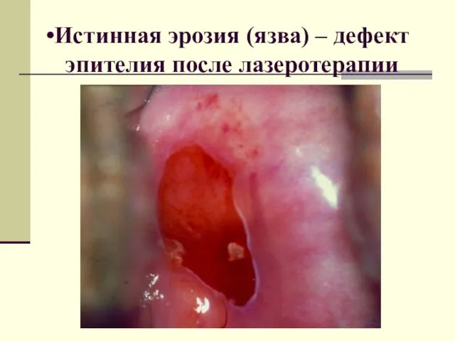 Истинная эрозия (язва) – дефект эпителия после лазеротерапии