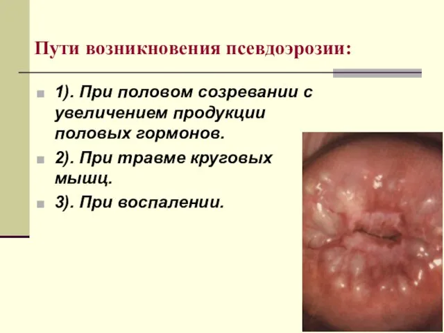 Пути возникновения псевдоэрозии: 1). При половом созревании с увеличением продукции половых гормонов.