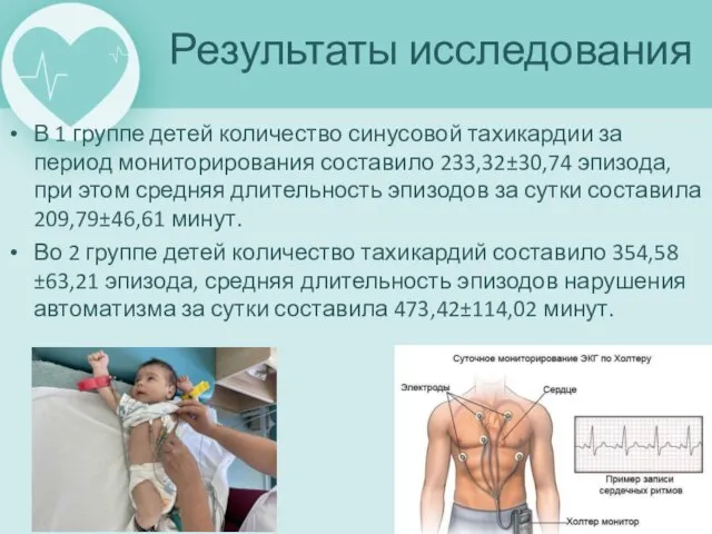 В 1 группе детей количество синусовой тахикардии за период мониторирования составило 233,32±30,74