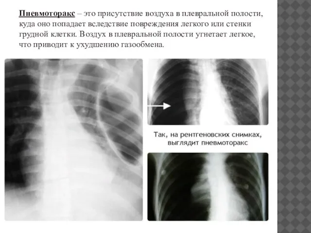 Пневмоторакс – это присутствие воздуха в плевральной полости, куда оно попадает вследствие