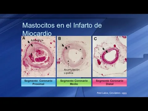 Mastocitos en el Infarto de Miocardio Adventicia Acumulación Lípidica Segmento Coronario Proximal
