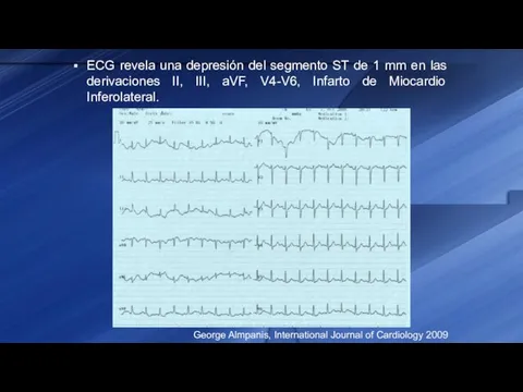 ECG revela una depresión del segmento ST de 1 mm en las